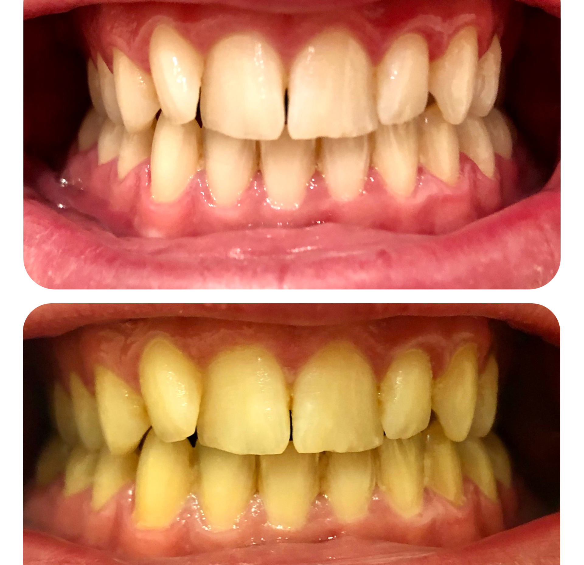 Comparaison de la teinte des dents